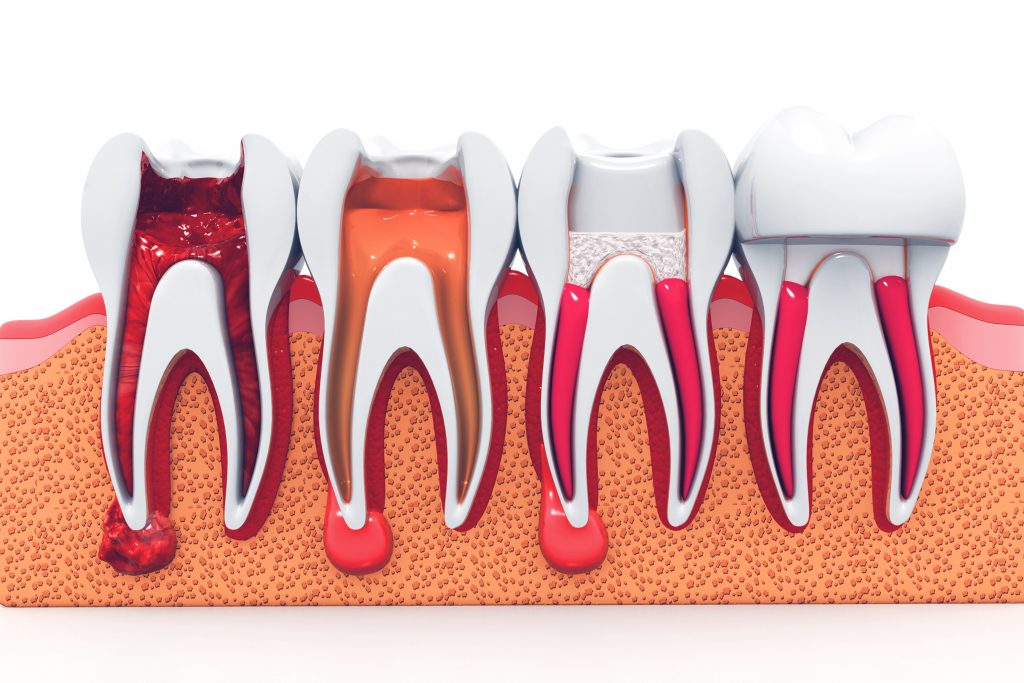 stages of a root canal treatment